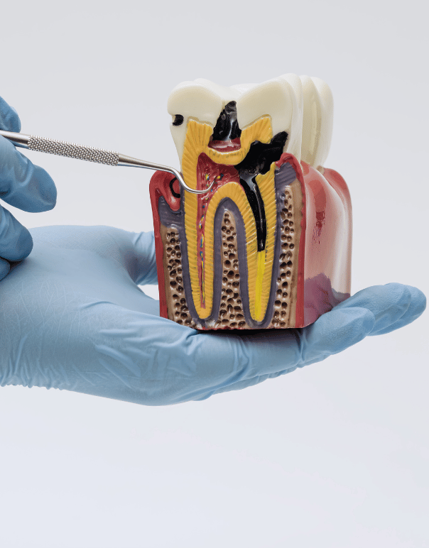 Root Canal Treatment